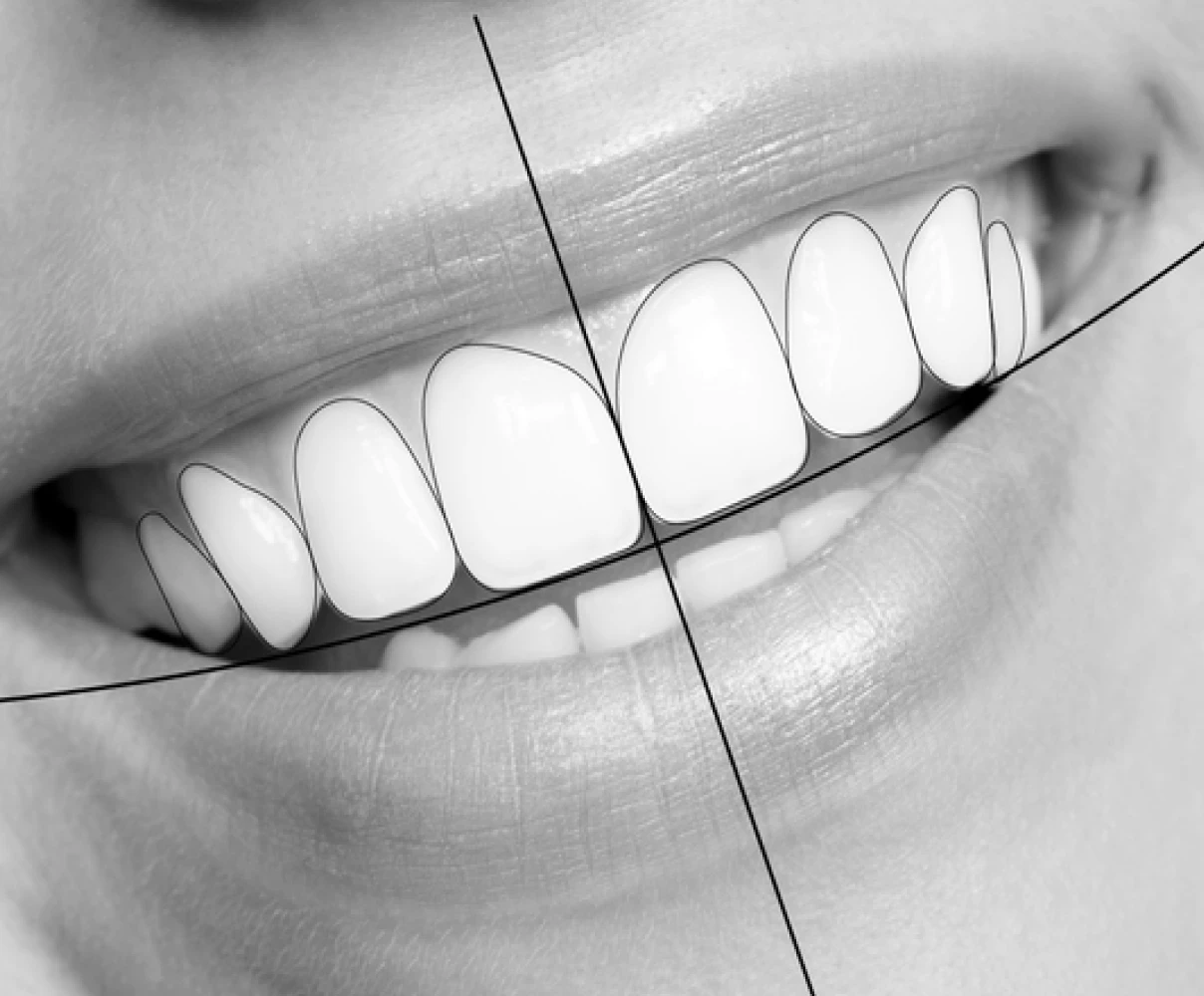 Les facettes 3 Digital Smile Design par Dr Marta Hidalgo