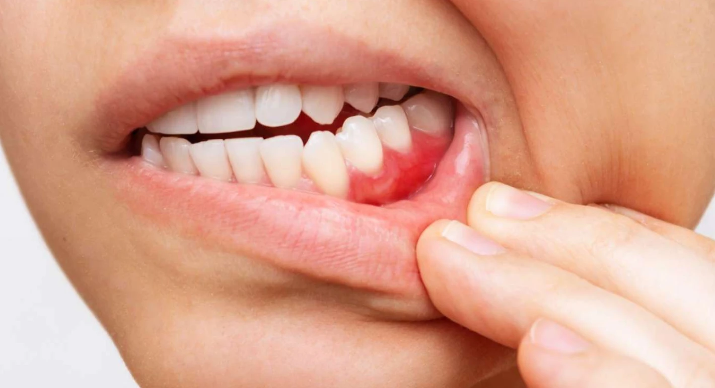 Soin des gencives 1 Inflammation de gencive