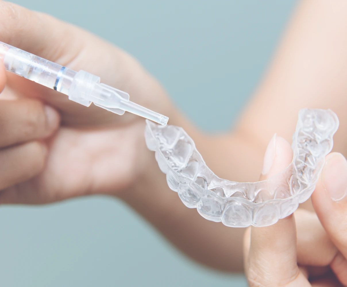 L’éclaircissement dentaire 3 Application du gel de blanchiment sur la gouttière invisible