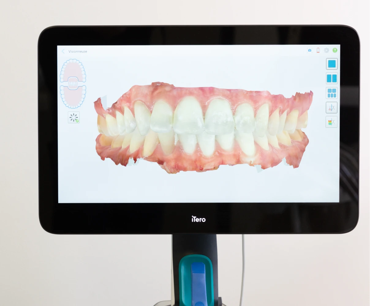 Les facettes 2 Technologie Itero pour la prise d'empreintes numériques