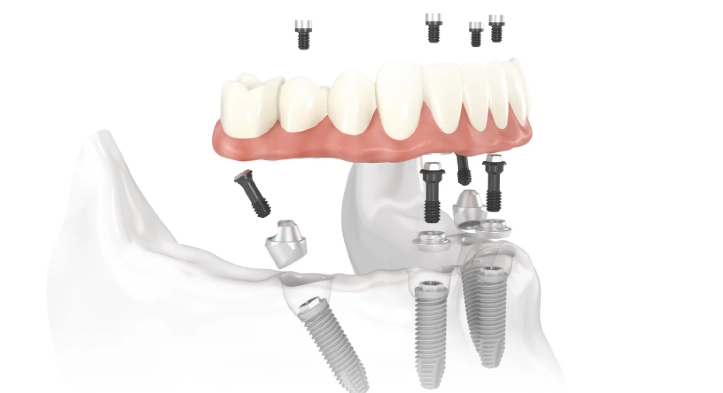 La prothèse sur implant 1 Prothèses complètes sur les implants