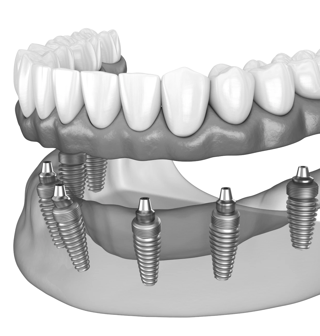 Prothèse complète sur implants