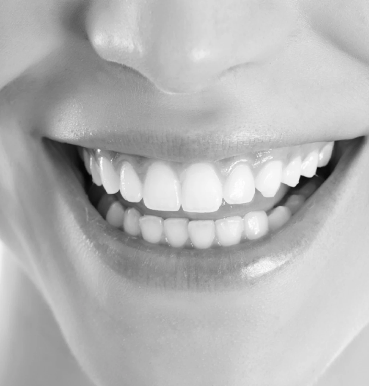 Sourire parfait après le traitement chez Dr Hidalgo