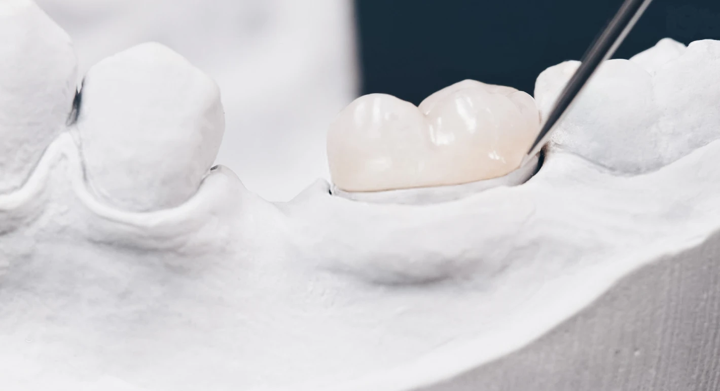 Prothèses fixes 2 Composite dentaire