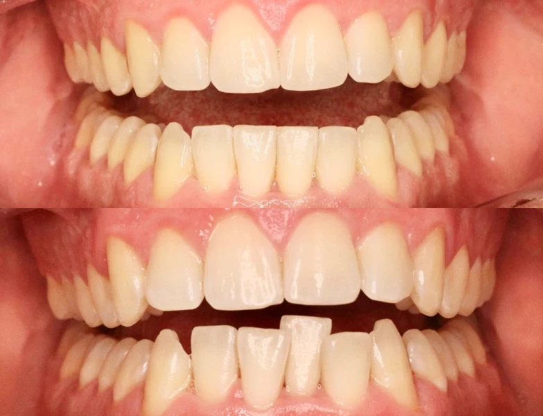 Résultat après la correction d'alignement par les gouttières Invisalign
